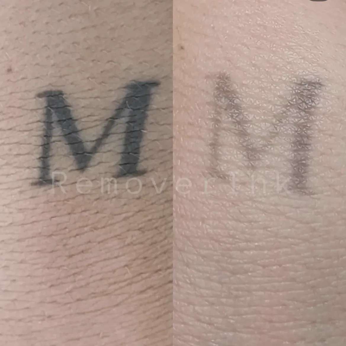 Antes y después real de una eliminación láser: letra inicial casi borrada en Black Rituals, Málaga