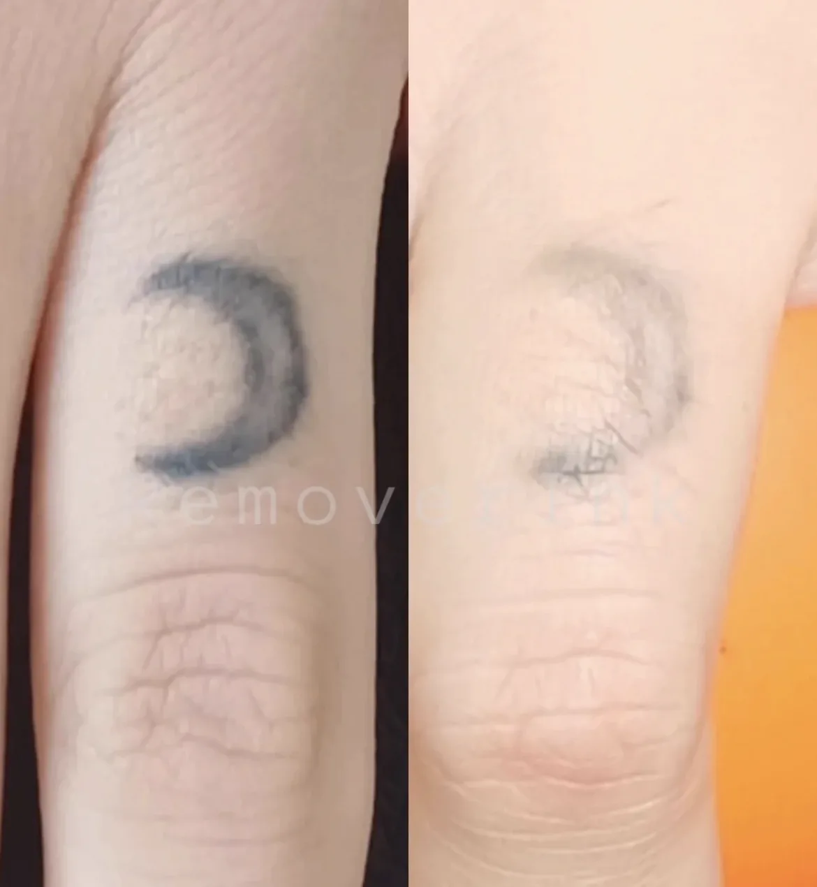 Antes y después real de una eliminación láser: luna en el dedo aclarada en Black Rituals, Málaga
