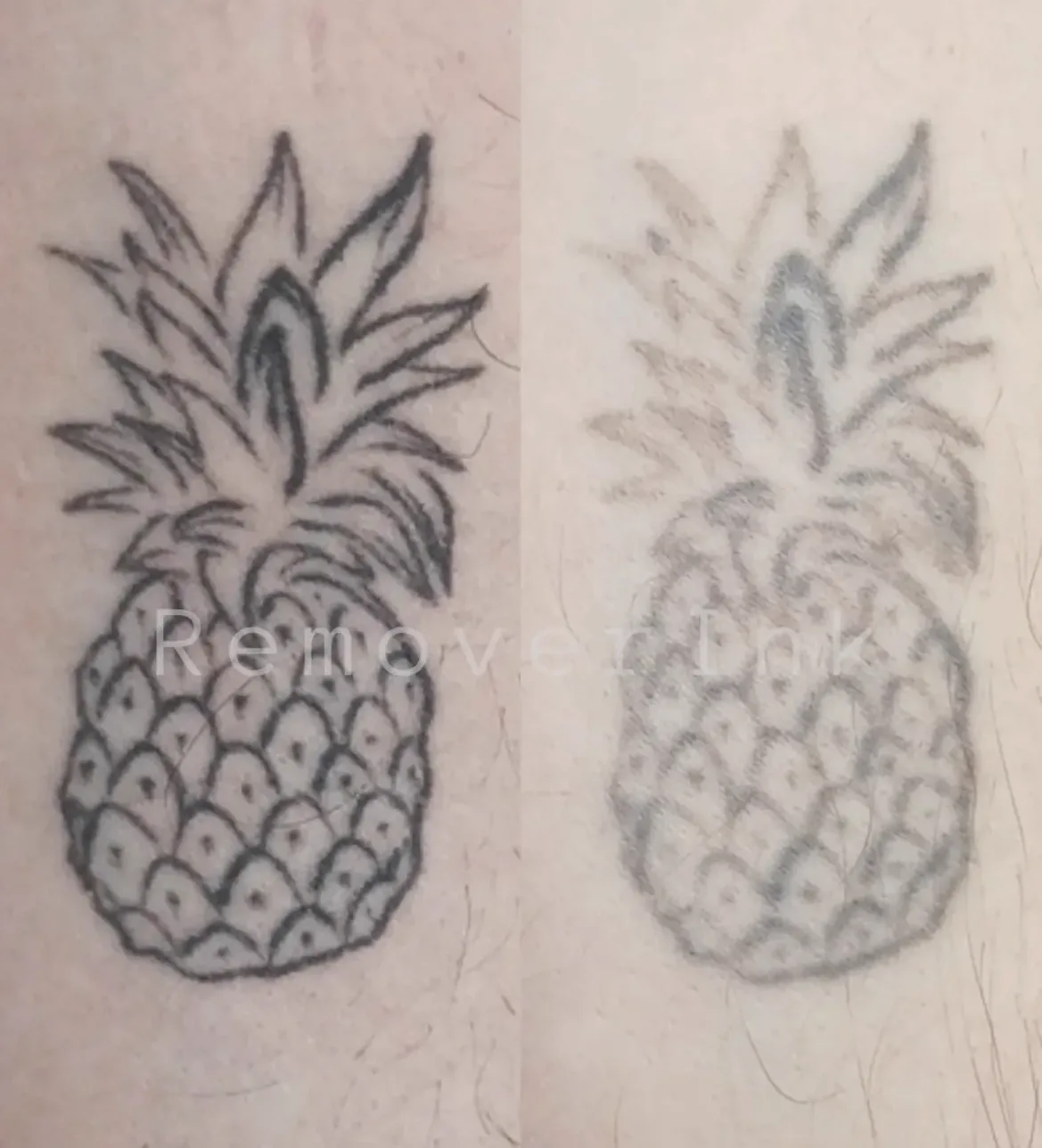 Antes y después real de una eliminación láser: tatuaje de piña aclarado en Black Rituals, Málaga